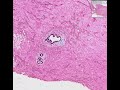 Histopathology Breast--Gynecomastia