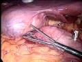 Laparoscopic Duodenal Switch from www.lapsf.com