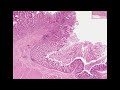 Histopathology Colon--Adenocarcinoma