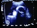 ??nar bebe?imiz yutkunurken bebek ultrason