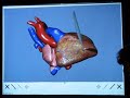 Virtual Heart Surgery