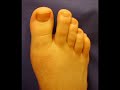 Toenail disorders  Nails Nail Diseases