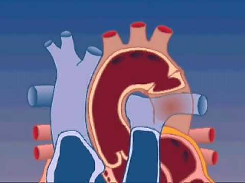 Coarctation of the Aorta