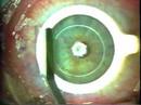 Cirurgia Ocular a Laser