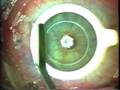 Cirurgia Ocular a Laser