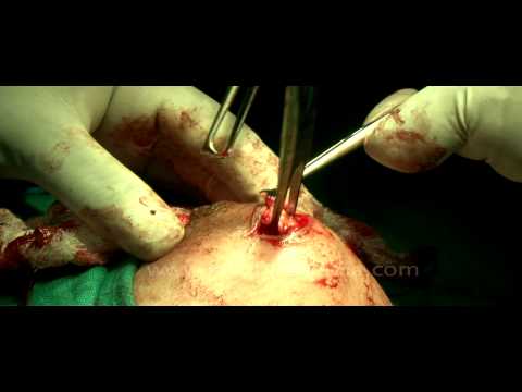 how to drain cyst in breast