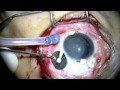 Sutureless Scleral Fixated PCIOL