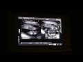 Me at my 19 Weeks 2 Days Ultrasound