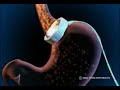 Lap Band in Stomach - how to band stomach