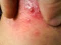 Cyst on my neck 2, gross (lots of puss)