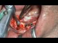 Implanturi dentare - clinica IMPLANTODENT
