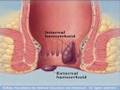 Hemorrhoids home remedies and cures