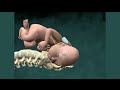 Animación Médica de 3D sobre el Distocia del Hombro Herido e