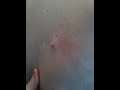 Callum's Pus Buddy
