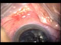 Another \"CataRock\" with Posterior hard plaque Another \"CataRock\" with Posterior hard plaque