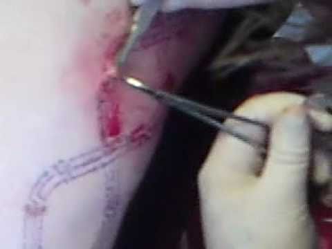 how to perform scarification