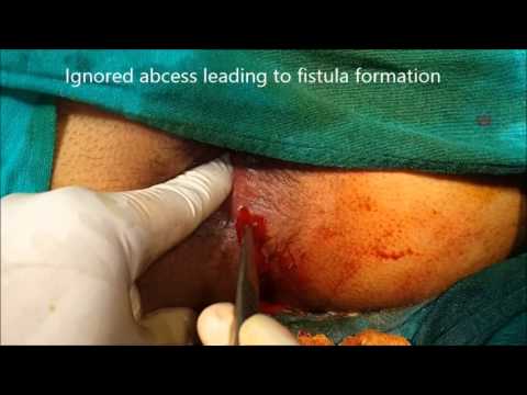 PERIANAL ABSCESS - Perianal Abscess Leading to fistula in ano detected during surgery helped it treat in same surgery.. What is Anal Fistula? An anal fistula is a small channel...