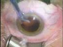 Modern Cataract Surgery Modern Cataract Surgery