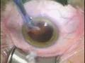 Modern Cataract Surgery