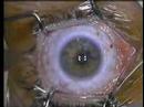 Lasik with Mechanical Microkeratome