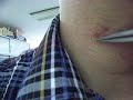 Ingrown hair