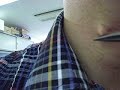 Ingrown hair came out like a ring! (Ingrown hair)