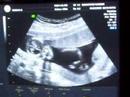Ecografia de nuestro tercer hijo/a Ecografia de nuestro tercer hijo/a