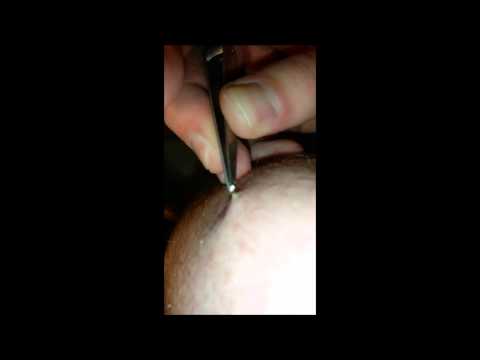 how to dissolve absorbable sutures