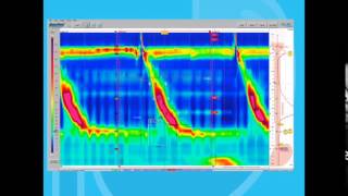 Esophageal Motility Disorders Part 1