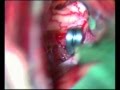 Brain Aneurysm (ACoA) Surgery, Aneurisma Cerebral (Thrace-Greece)