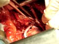 MINIINVASIVE CARDIAC SURGERY