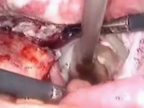how to repair ureteral injuries