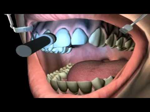how to whiten own teeth