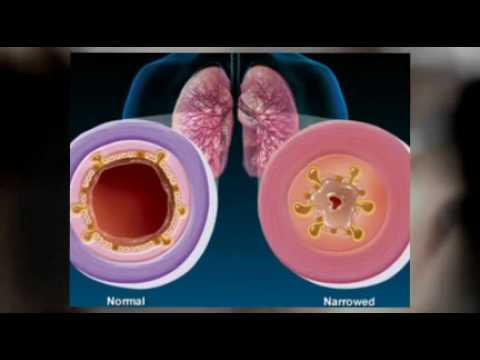 how to treat acute bronchitis