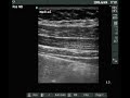 Ultrasound view of the lateral abdominal wall