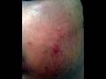 The Acne Practice  (Home Version 19)  -- Tried 