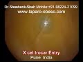Gastric Banding Obesity Video -Lapband Keyhole Lapbanding