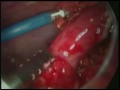 Manejo actual de la peritonitis generalizada por apendicitis