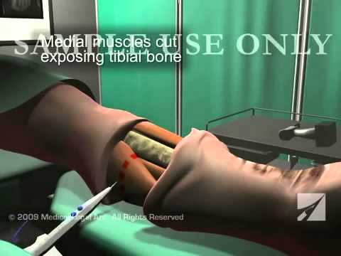 amputacion - Esta animación médica 3D ofrece una visión general del quirófano dramática de la pierna izquierda por debajo de la amputación quirúrgica de la rodilla despué...
