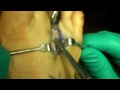 Dr. Patrick DeHeer, DPM - 3rd Metatarsal Osteotomy