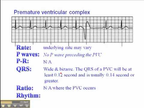 how to treat idioventricular rhythm