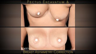 Kao Plastic Surgery - Pectus Excavatum and Breast Asymmetry Reconstruction - Before & After Results