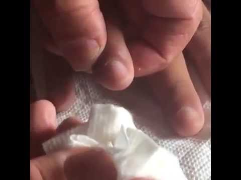 how to drain infected hangnail