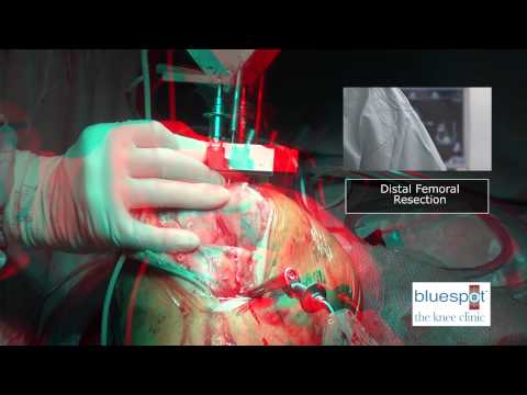3D Total Knee Replacement: Bone Cuts - YouTube