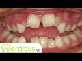 Dental patient education - Connective tissue graft