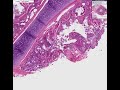 Histopathology Lung, lymph node --Asthma Histopathology Lung, lymph node --Asthma