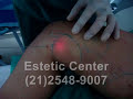 LipoLaser - Lipo laser - Lipo - Estetic Center
