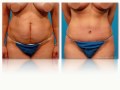 Abdominoplasty - Tummy Tuck - Informational Video - Michael Bogdan - Dallas Texas