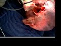 CDexpandable prosthesis for sutureless aorta anast. in 2 min CDexpandable prosthesis for sutureless aorta anast. in 2 min