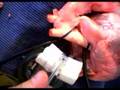 CDexpandable prosthesis for sutureless aorta anast. in 2 min